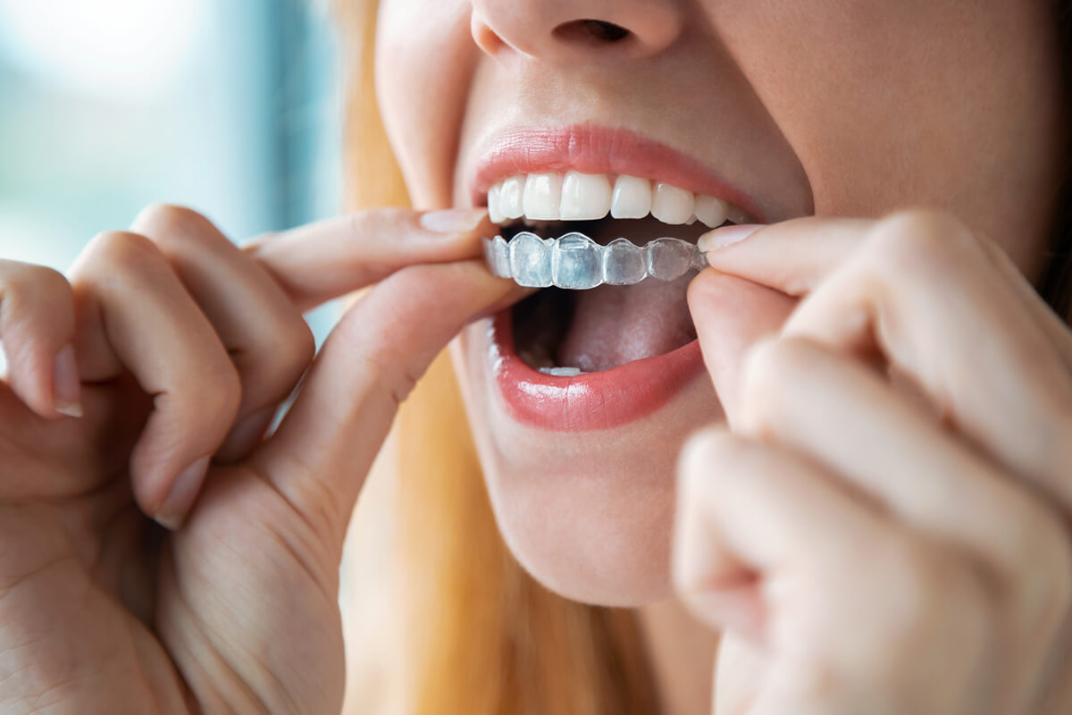 Invisible Braces: A Game Changer in Teeth Alignment